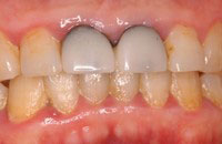歯周病およびセラミックス治療前症例